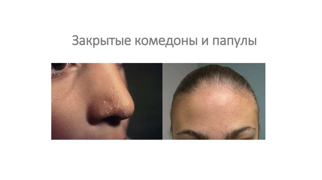 Закрытые комедоны и папулы