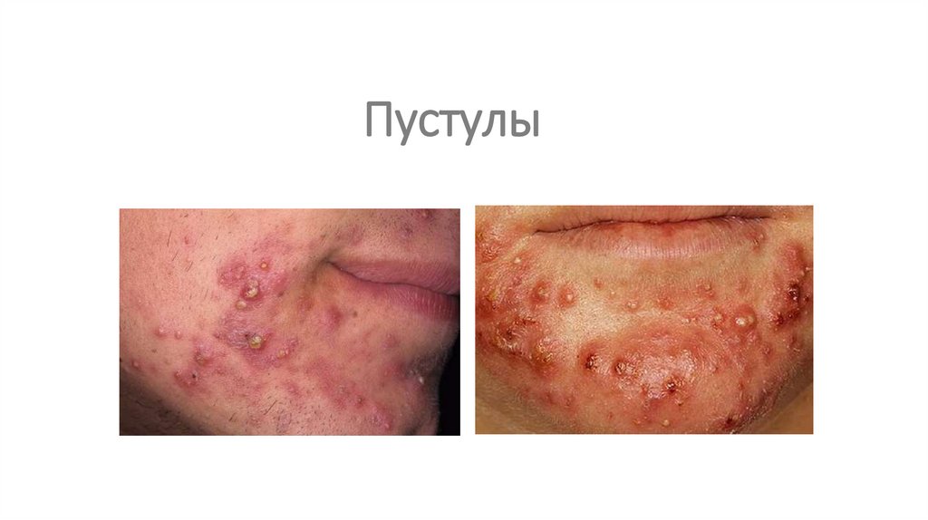 Пустулы