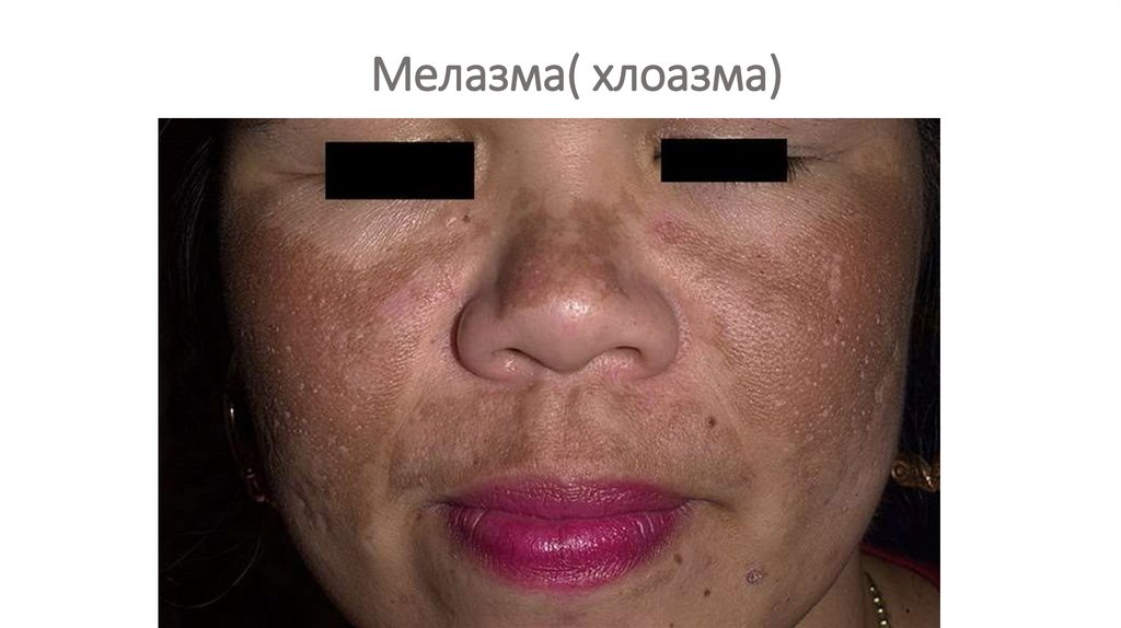 Мелазма( хлоазма)