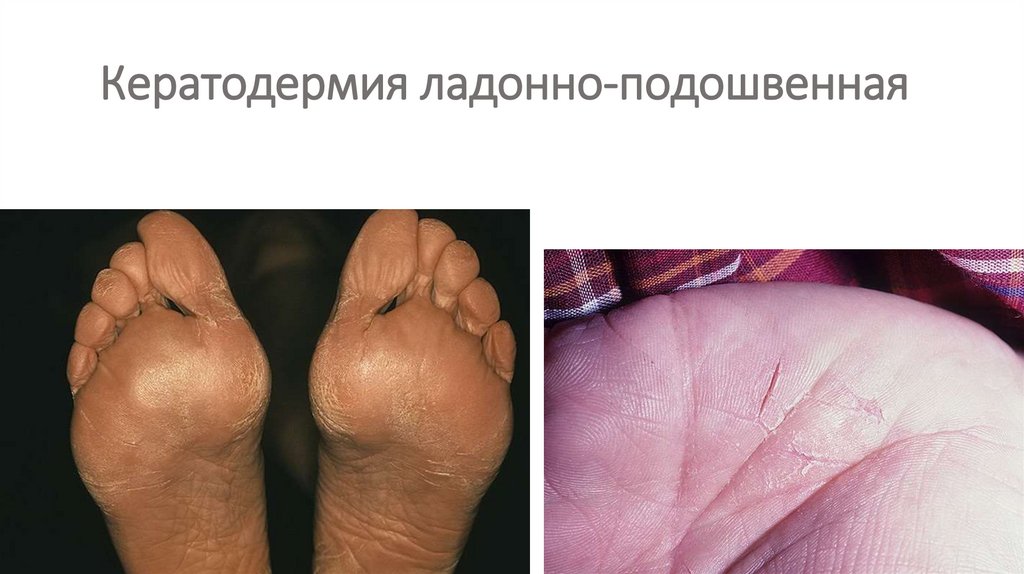 Кератодермия ладонно-подошвенная