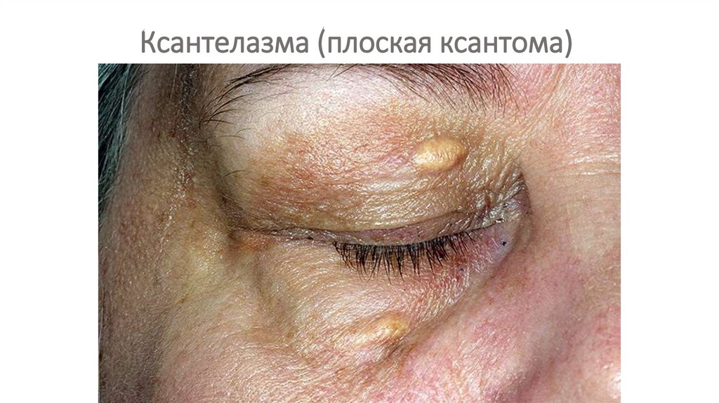 Ксантелазма (плоская ксантома)