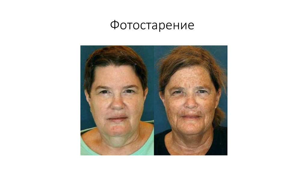 Фотостарение