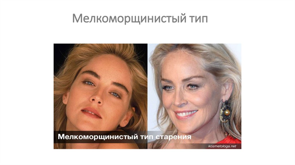 Мелкоморщинистый тип