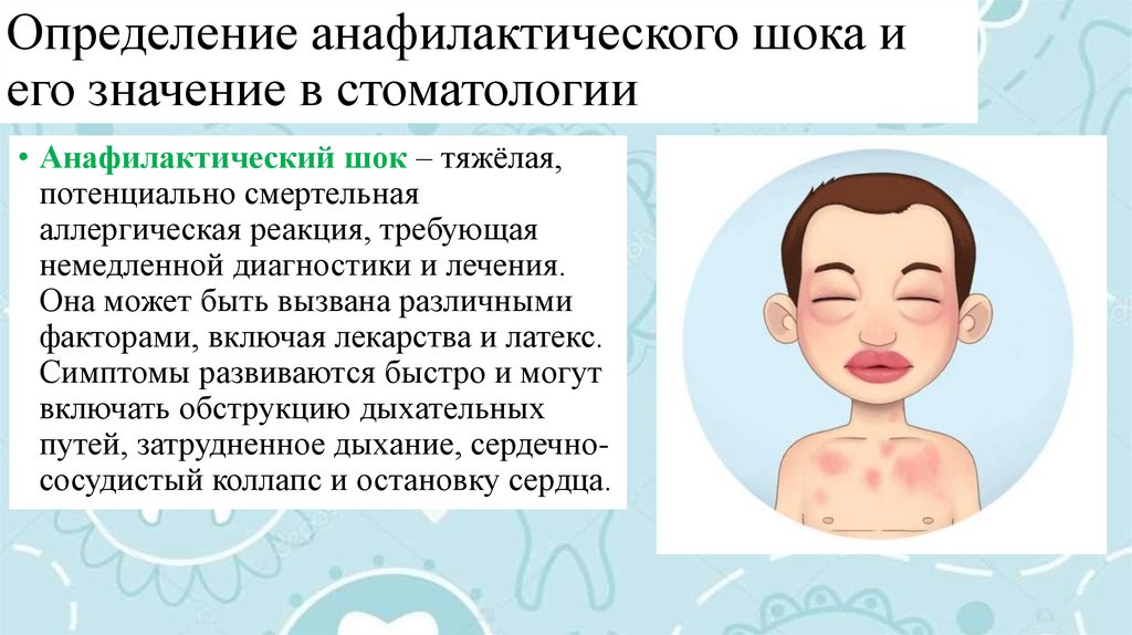 Определение анафилактического шока и его значение в стоматологии