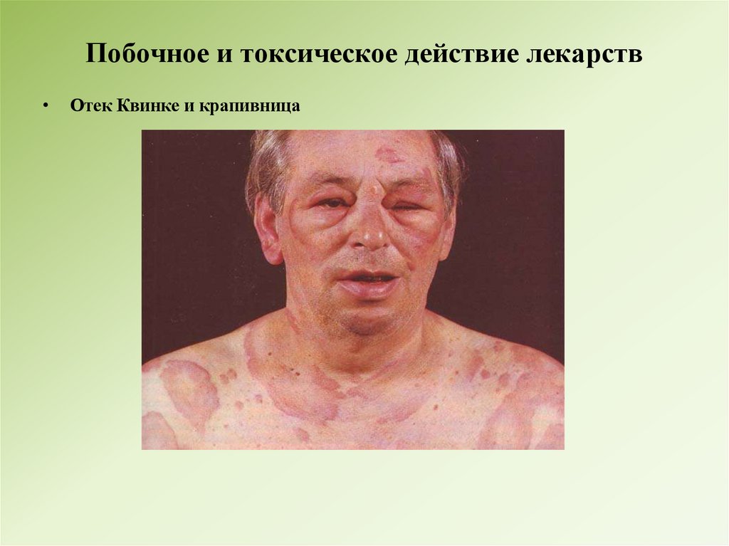 Побочное и токсическое действие лекарств