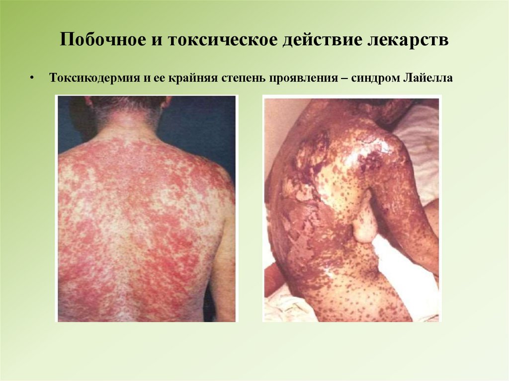 Побочное и токсическое действие лекарств