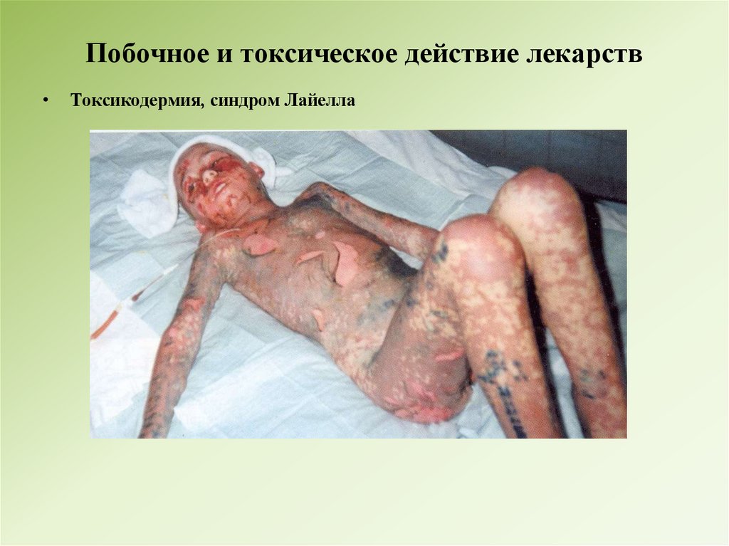 Побочное и токсическое действие лекарств