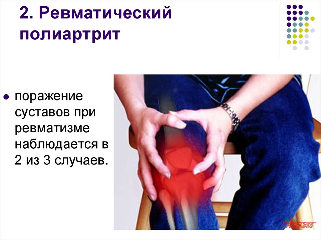 2. Ревматический полиартрит