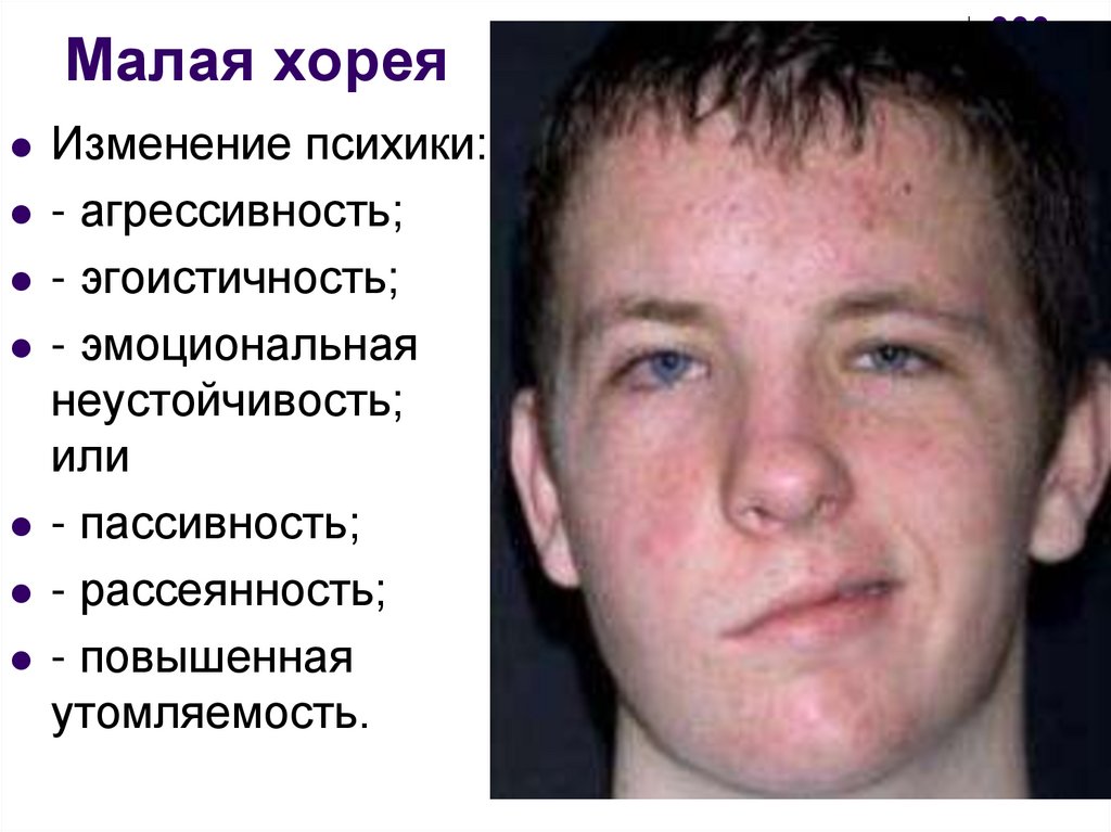 Малая хорея