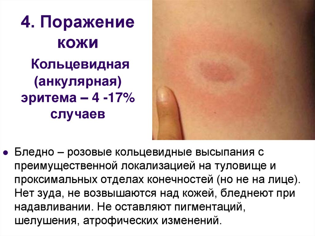 4. Поражение кожи Кольцевидная (анкулярная) эритема – 4 -17% случаев