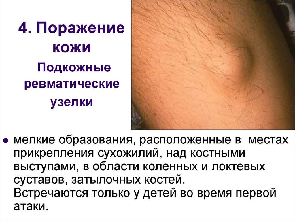 4. Поражение кожи Подкожные ревматические узелки