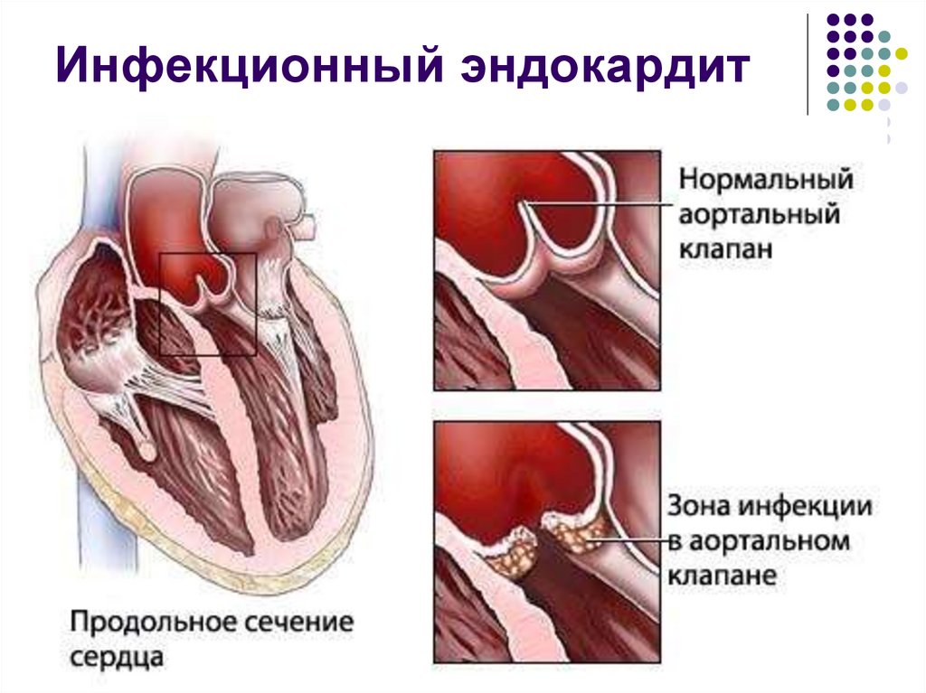 Инфекционный эндокардит