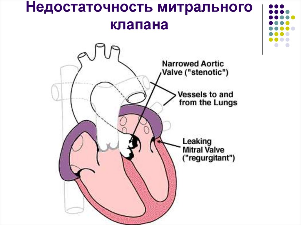 Недостаточность митрального клапана