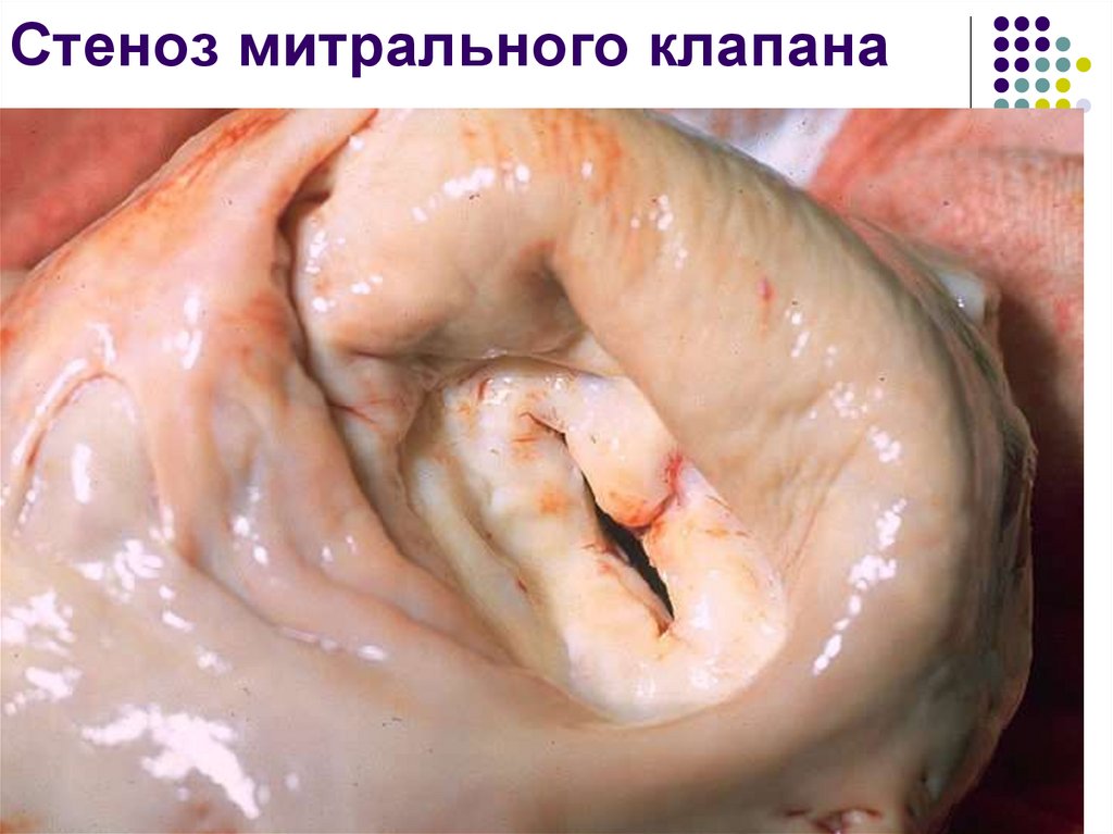 Стеноз митрального клапана