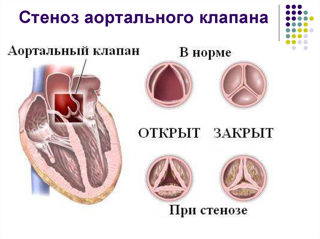 Стеноз аортального клапана