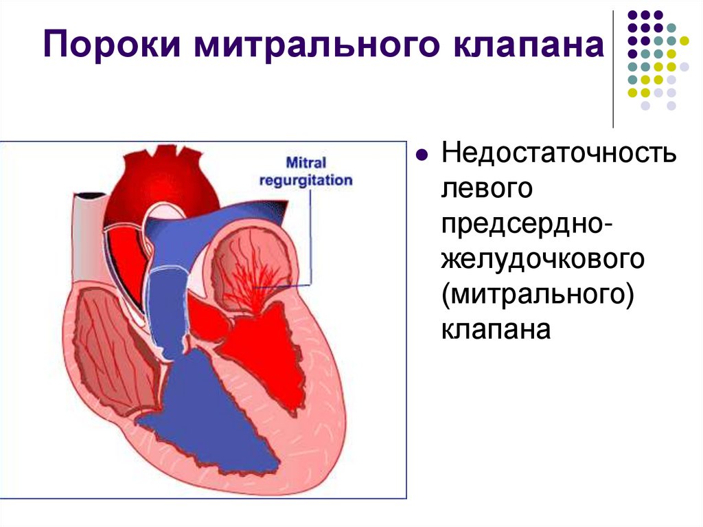Пороки митрального клапана