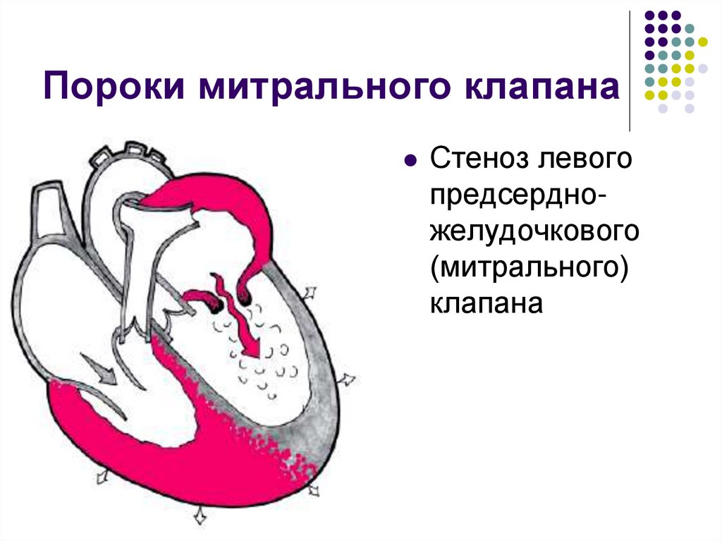 Пороки митрального клапана