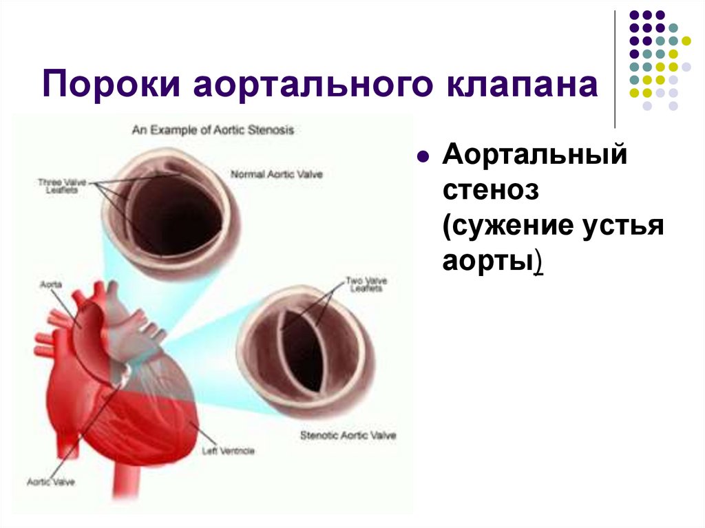 Пороки аортального клапана
