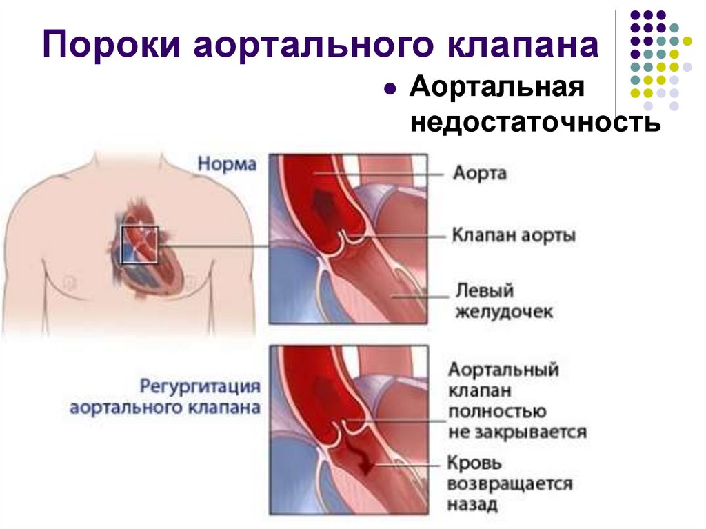 Пороки аортального клапана