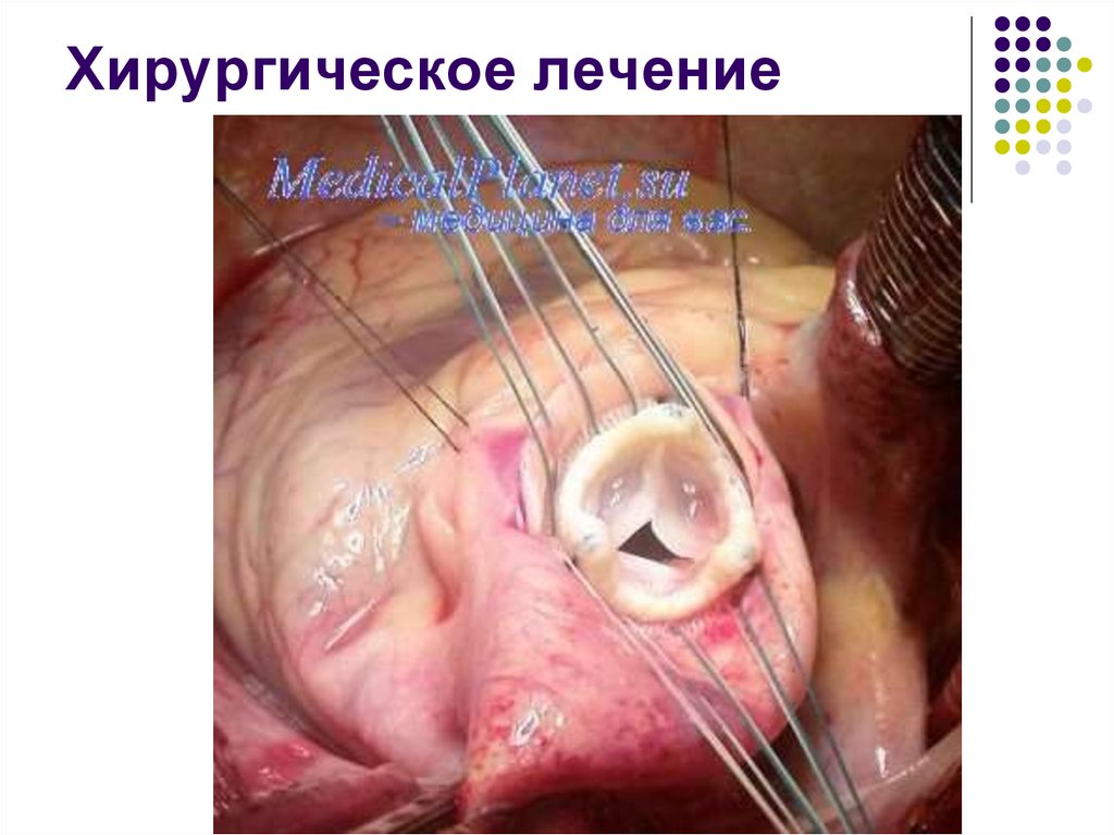 Хирургическое лечение