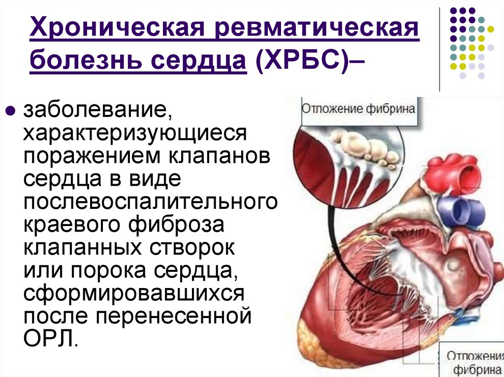 Хроническая ревматическая болезнь сердца (ХРБС)–