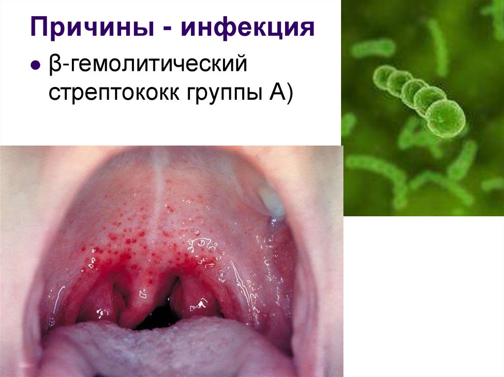 Причины - инфекция