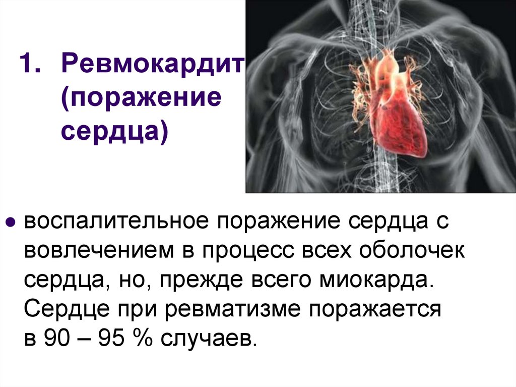 Ревмокардит (поражение сердца)
