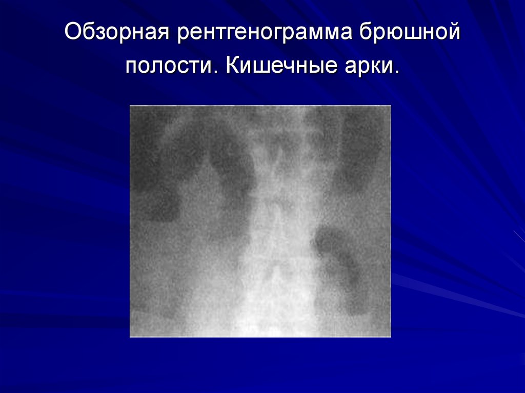 Обзорная рентгенограмма брюшной полости. Кишечные арки.