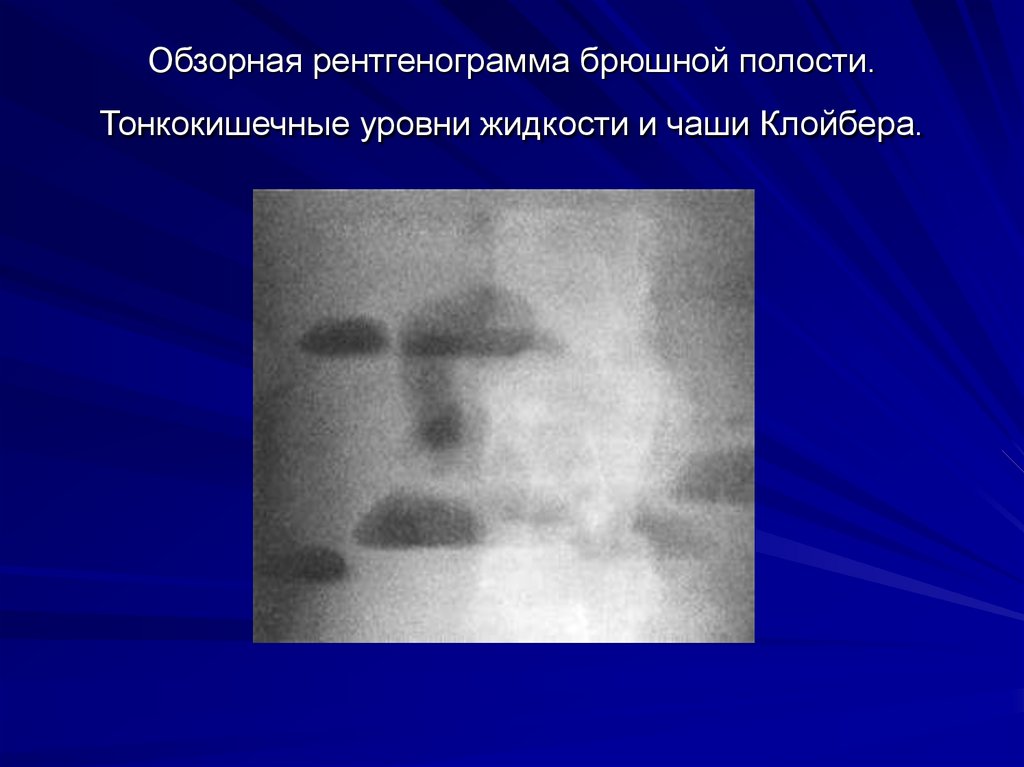 Обзорная рентгенограмма брюшной полости. Тонкокишечные уровни жидкости и чаши Клойбера.