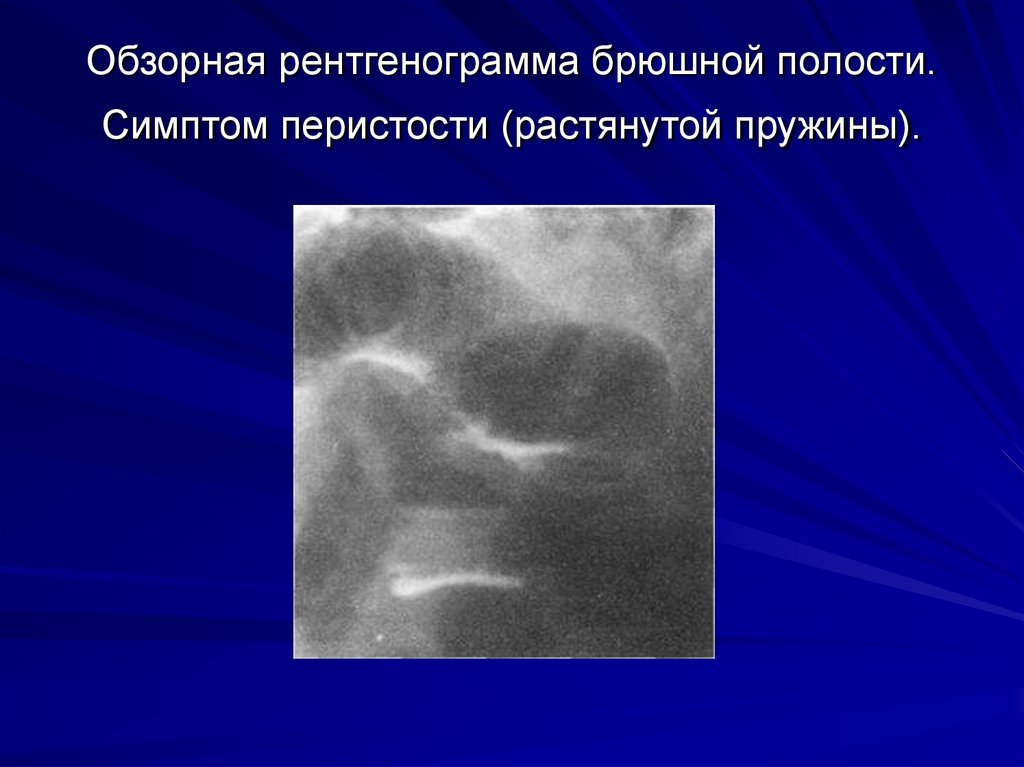 Обзорная рентгенограмма брюшной полости. Симптом перистости (растянутой пружины).
