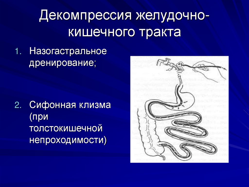 Декомпрессия желудочно-кишечного тракта