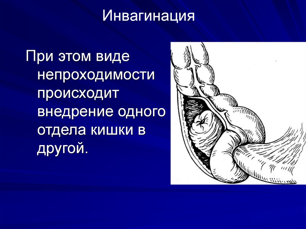 Инвагинация