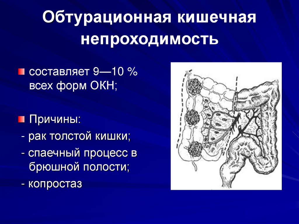 Обтурационная кишечная непроходимость