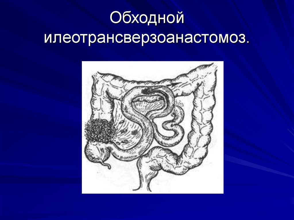 Обходной илеотрансверзоанастомоз.