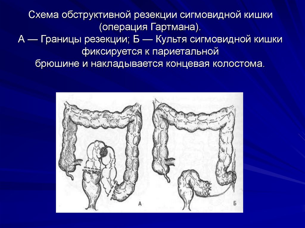 Схема обструктивной резекции сигмовидной кишки (операция Гартмана). А — Границы резекции; Б — Культя сигмовидной кишки