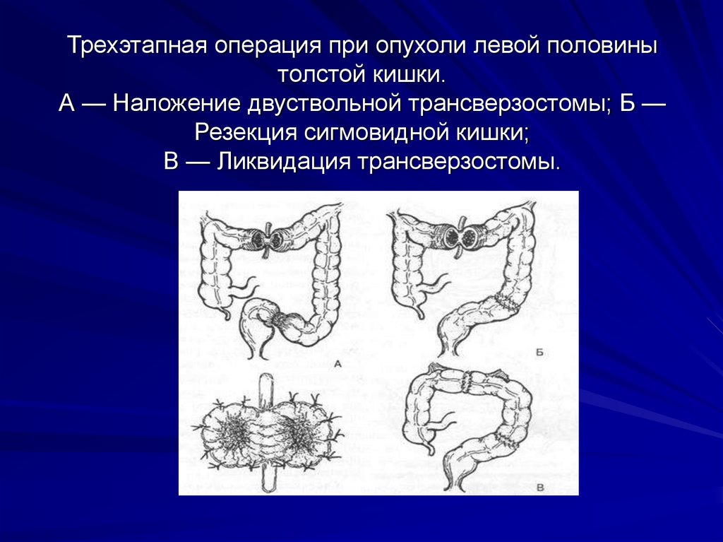 Трехэтапная операция при опухоли левой половины толстой кишки. А — Наложение двуствольной трансверзостомы; Б — Резекция