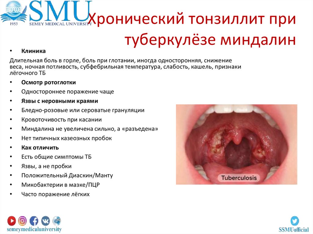 Хронический тонзиллит при туберкулёзе миндалин