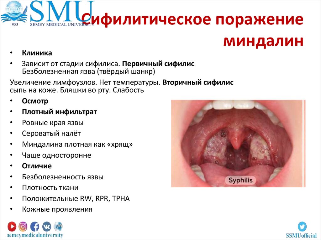 Сифилитическое поражение миндалин