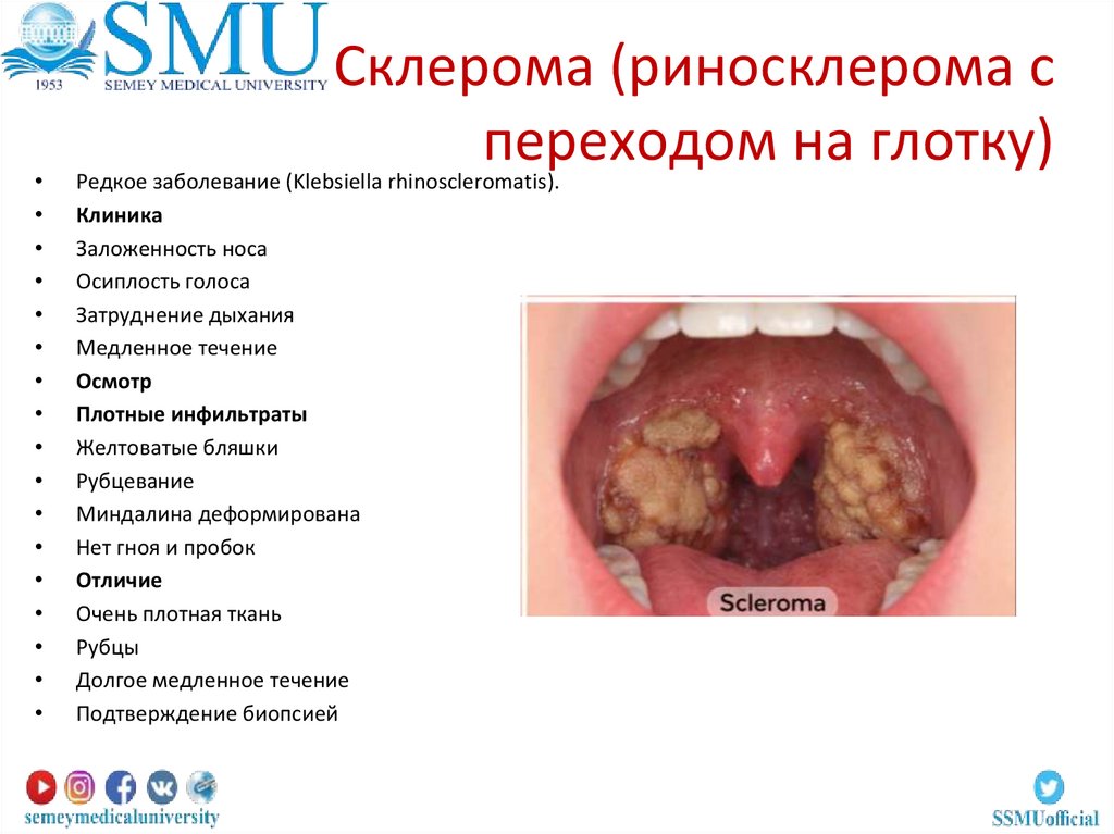 Склерома (риносклерома с переходом на глотку)