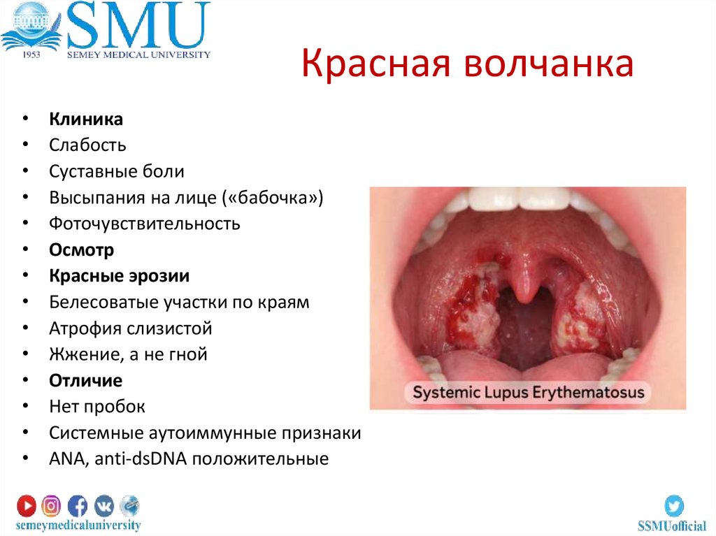 Красная волчанка