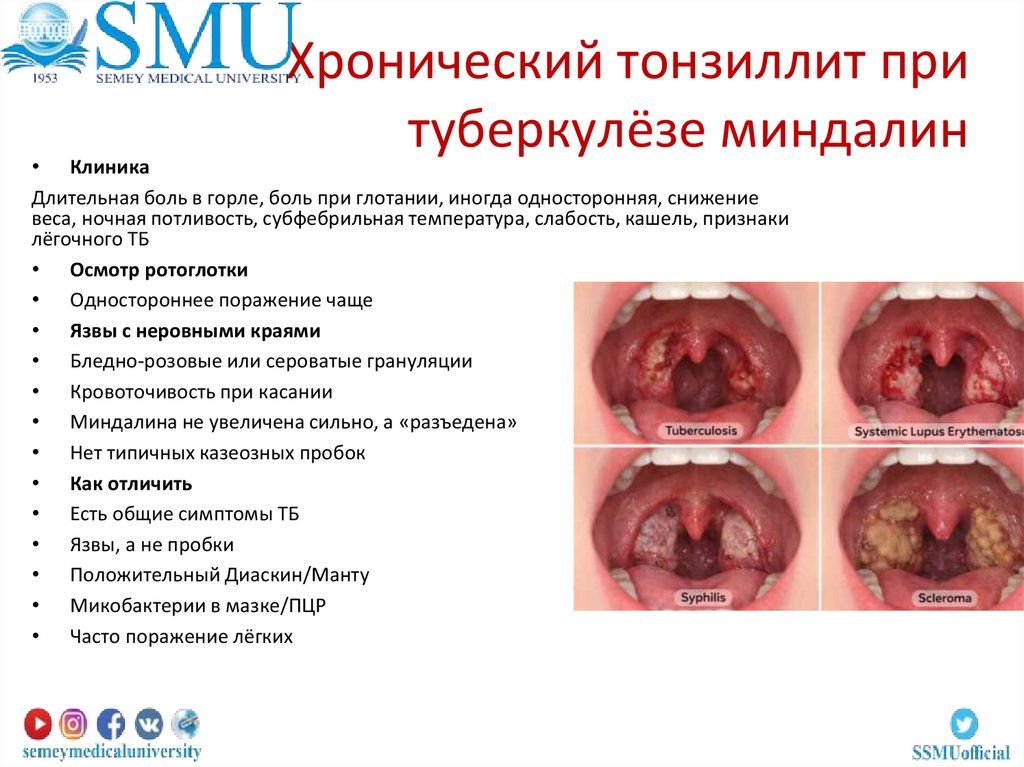 Хронический тонзиллит при туберкулёзе миндалин