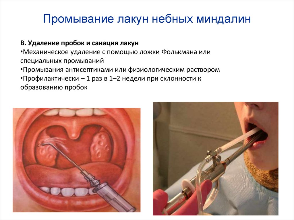 Промывание лакун небных миндалин
