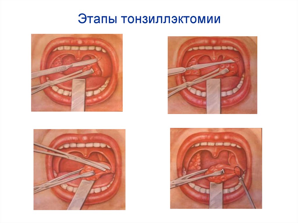 Этапы тонзиллэктомии