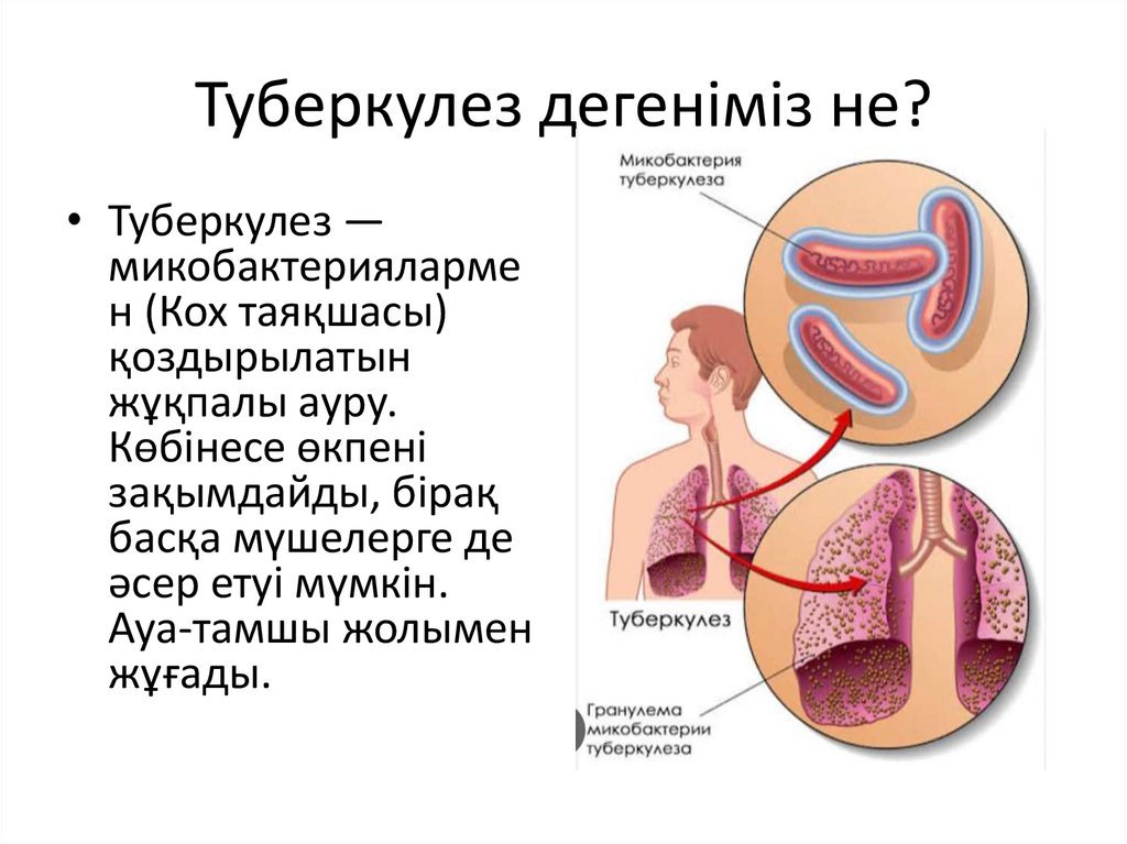 Туберкулез дегеніміз не?
