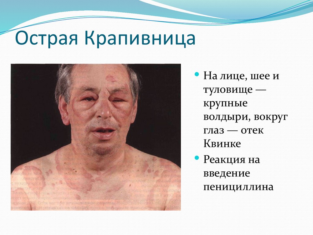 Острая Крапивница