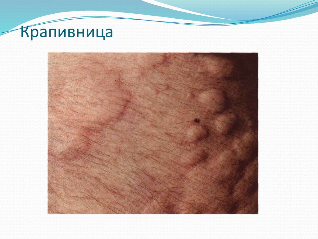 Крапивница