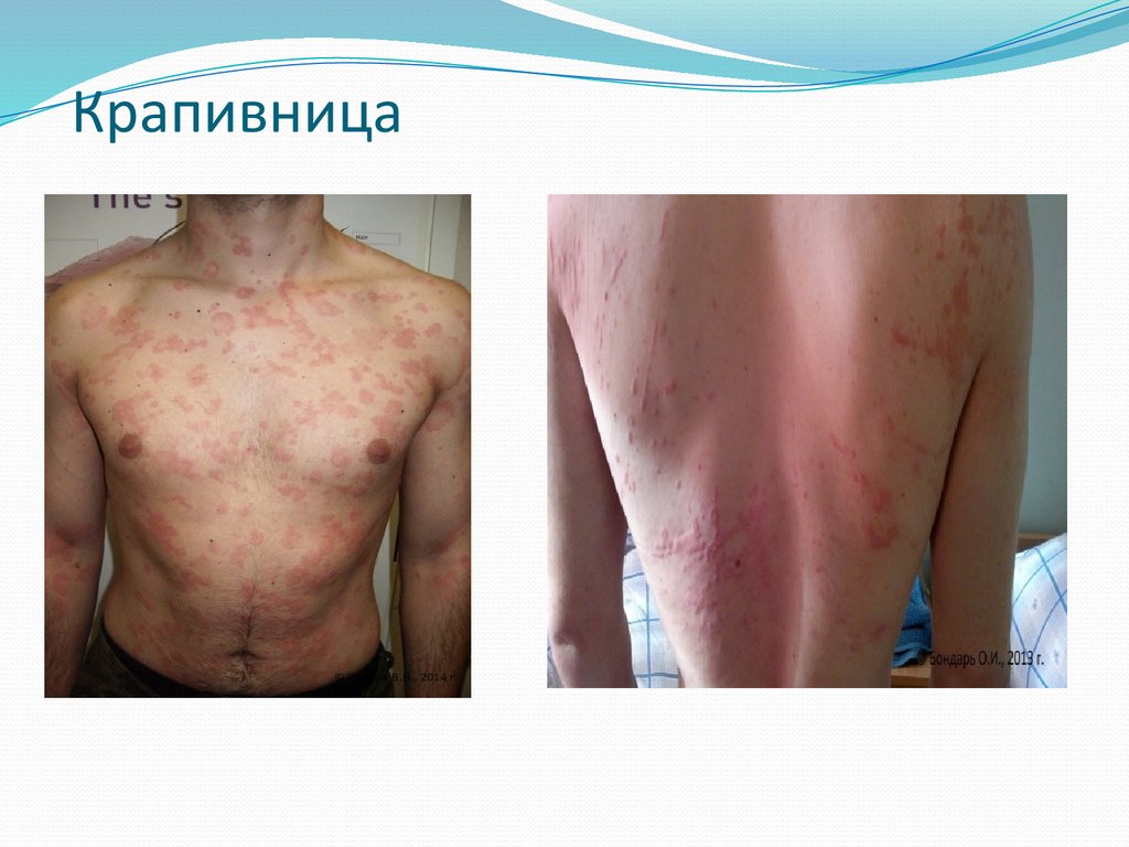 Крапивница