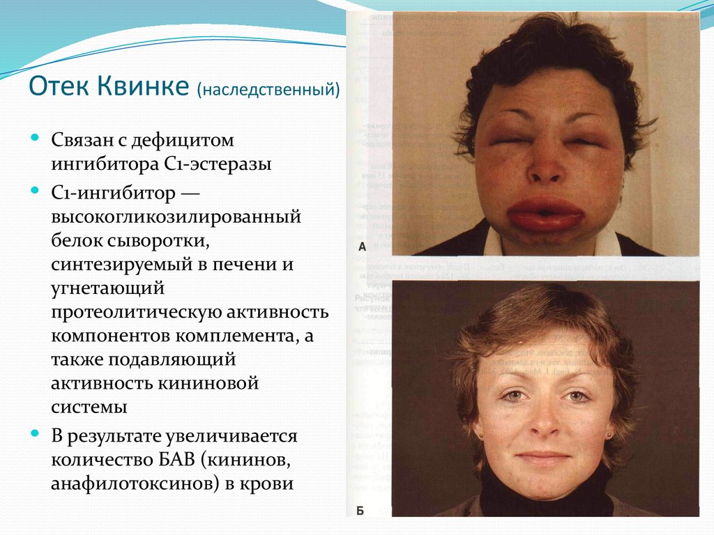 Отек Квинке (наследственный)