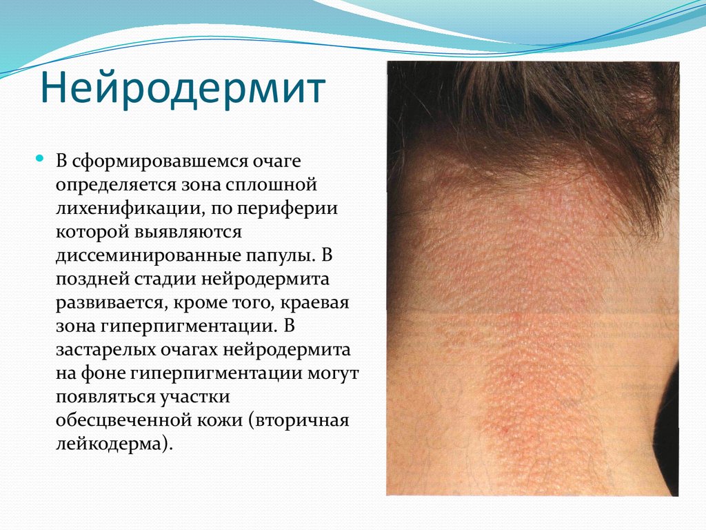 Нейродермит