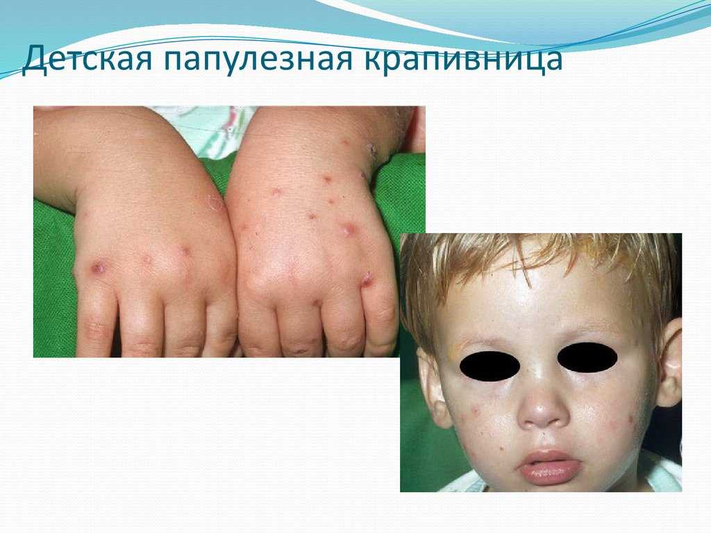 Детская папулезная крапивница